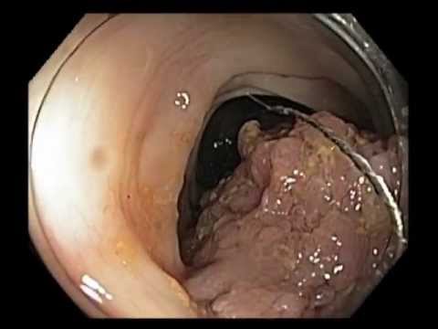 Giant Pedunculated Polyp in Sigmoid Colon