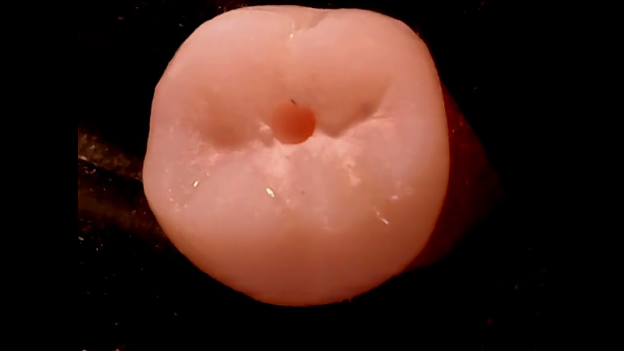MOLAR INFERIOR
