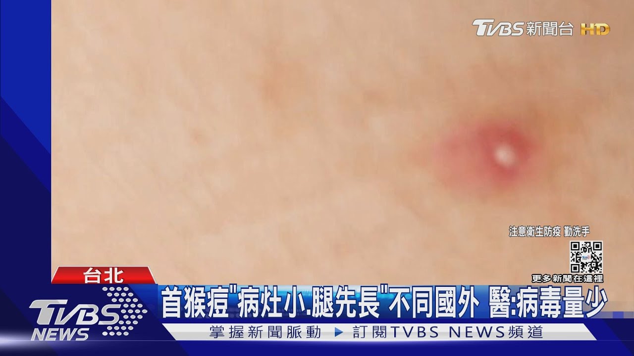 猴痘可1染2!防共用「衣服、床單」 長痘前就會傳
