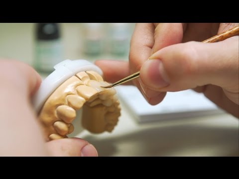 3D Druck im Dentallabor: Digitale Fertigung von provisorischen Kronen & Brücken mit Freeprint® temp