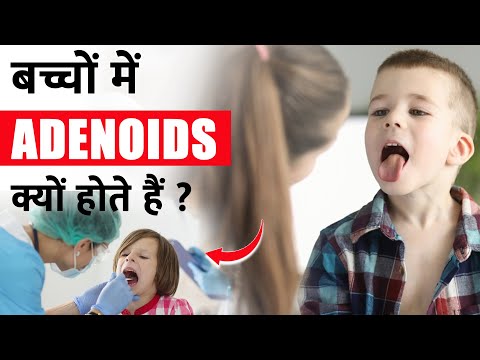 Enlargement in children | Adenoids क्या हैं | Treatment of Adenoid Enlargement without Operation