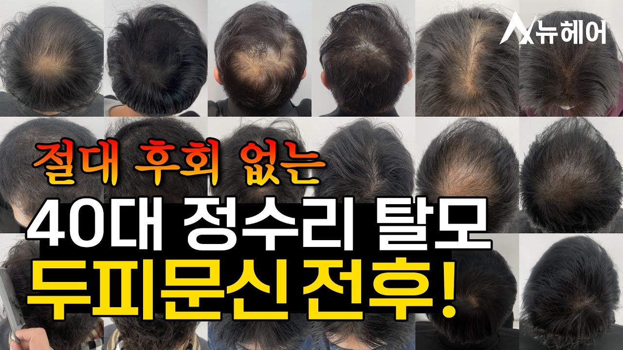 두피문신 후회 없는 40대 정수리 가르마 smp 전후사진ㅣ뉴헤어