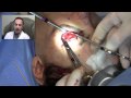 Face Lift Surgery 