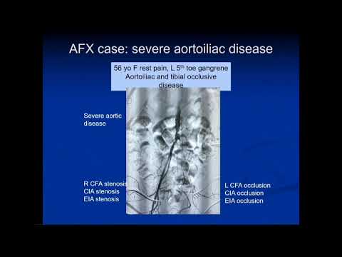 CVI 2019_Friday 7/19_ Aortoiliac Disease _Norman Kumins, MD