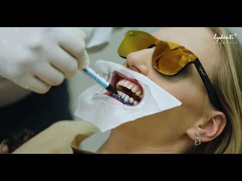Lydenti Zahnaufhellung Bleaching Whitening