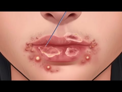 Video cover