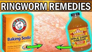 8 Best Natural Home Remedies For RINGWORM TREATMENTS