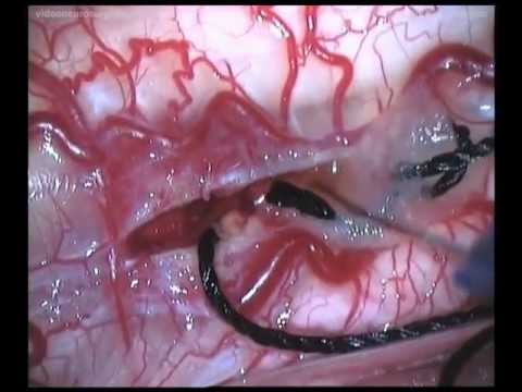 Cervical Intramedullary Astrocytoma - Posterior Approach 