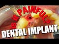 Dental Implant | NO FEAR | Dental Implant Procedure