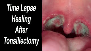 Tonsillectomy Time Lapse Healing Day by Day From Day 0 - Day 25