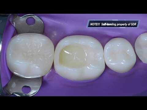 Restoration of posterior teeth