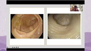 CDHF Talks: The Transformative Role of Intestinal Ultrasound in Diagnosing and Monitoring IBD