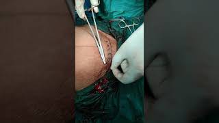 LSCS step by step for triplet with first one breech  by Dr MD SHAMIM NAWAZ at Anantraj hospital
