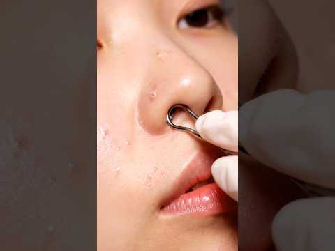 Pure Glow ASMR | Gentle Whitehead Extraction & Deep Skin Cleaning Therapy 🌿💆‍♀️😌 #cleansingsoap