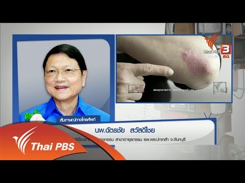 กลากและโรคผิวหนังที่ได้รับการรักษาเส้นเลือดขอด ประวัติโรคผิวหนังภูมิแพ้