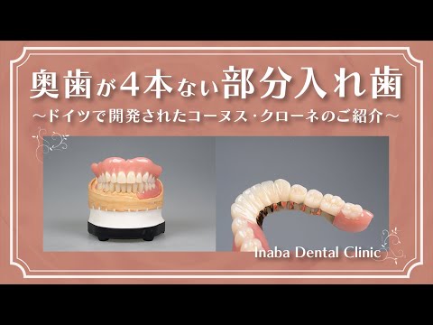 奥歯が4本ない場合の部分入れ歯について〜ドイツで開発されたコーヌス・クローネのご紹介〜