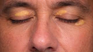 চোখের পাতায় চর্বি জমা (Xanthelasma) এর কারণ ও চিকিৎসা!