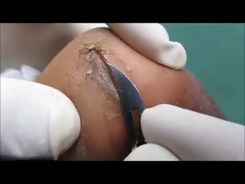 Kuko halamang-singaw at baking soda Fungus singit kung ano ang doktor treats
