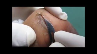 Debridement Of Cracked Heels