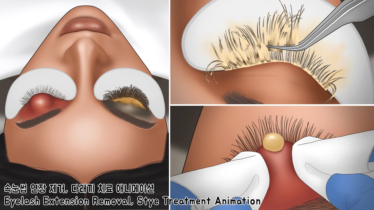 ASMR 뭉치고 오래된 속눈썹 연장 제거 & 왕 다래끼 치료 애니메이션 | Lash Deep Cleaning & Stye Treatment Animation