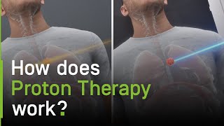 How Does Proton Therapy Work?