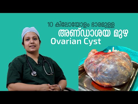 10 കിലോ വരുന്ന അണ്ഡാശയത്തിലെ സിസ്റ്റിനെ ഓപ്പറേഷനിലൂടെ മാറ്റിയപ്പോൾ | KIMS Alshifa Perinthalmanna