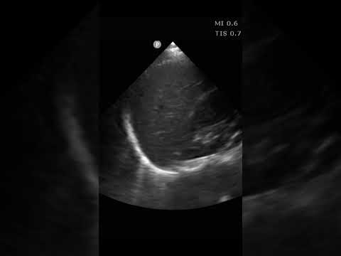 B Lines in the Angle  #pocus #ultrasound #emergencymedicine
