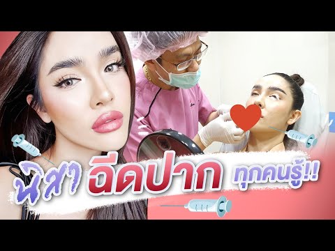 ฉีด ฟิลเลอร์ ปาก
