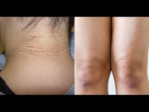 Как сделать веснушки в фш Печеночная пигментация на лице лечение