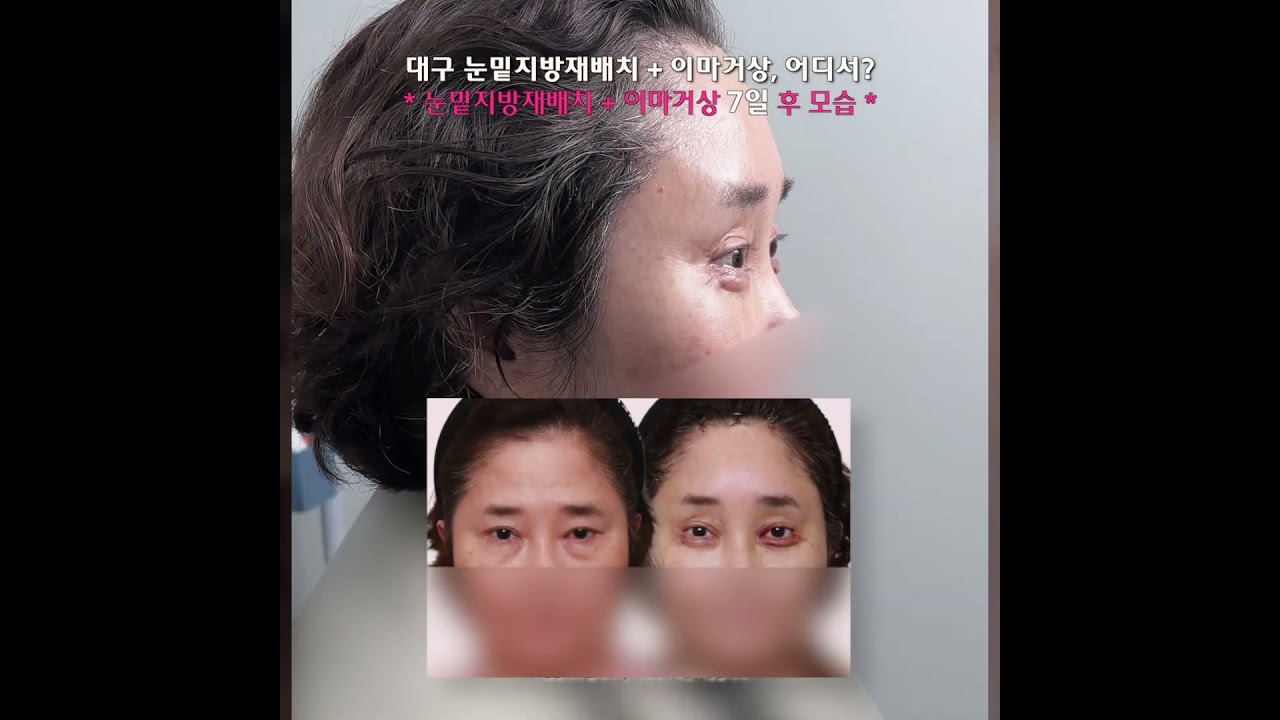 50대 꼬집 눈밑지방재배치 + 내시경이마거상