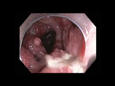 Inflammatory Polyposis in Colonoscopy