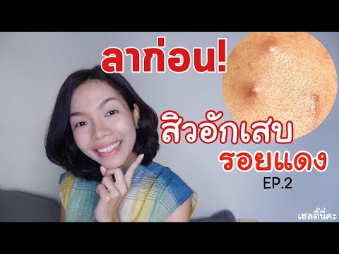 เสริมคลินิกเต้านมปีเตอร์ เด็กอายุ 3 เดือน suckles เล็ก ๆ น้อย ๆ