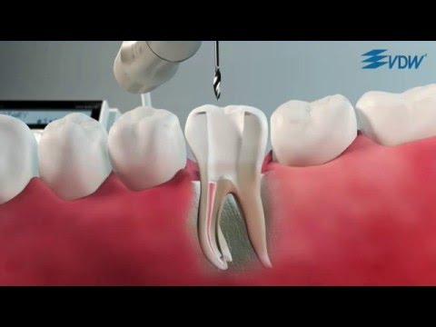 RECIPROC  Revision mit RECIPROC R25