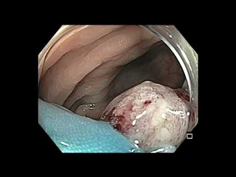 Coloscopie: mucosectomie endoscopique du polype du côlon sigmoïde après deux résections antérieures incomplètes 