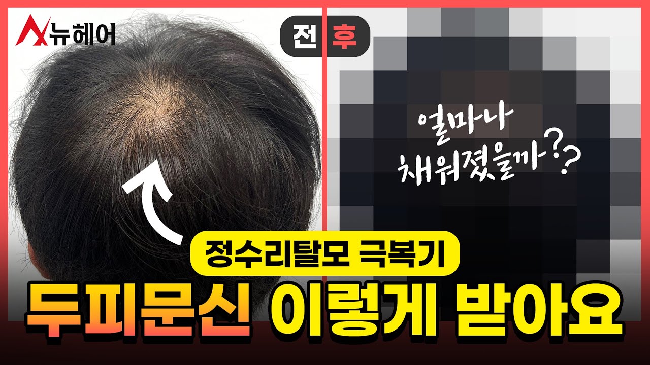 头顶头皮纹身真实后记 ｜头顶脱发克服记 ｜ New Hair