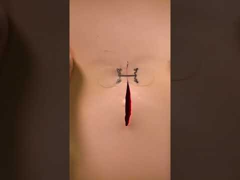 Close that open wound quickly