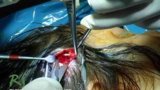 How To Perform an Ethnic Rhinoplasty w/ Dr. Nassif