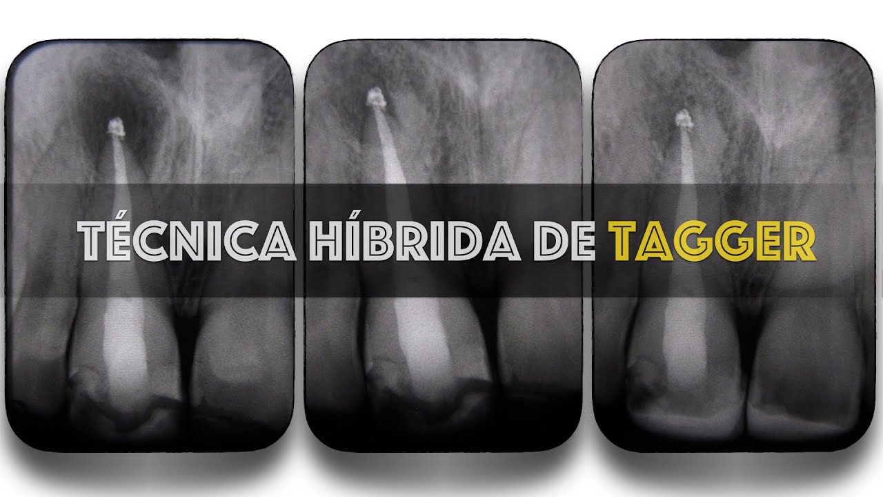 Técnica  híbrida de Tagger