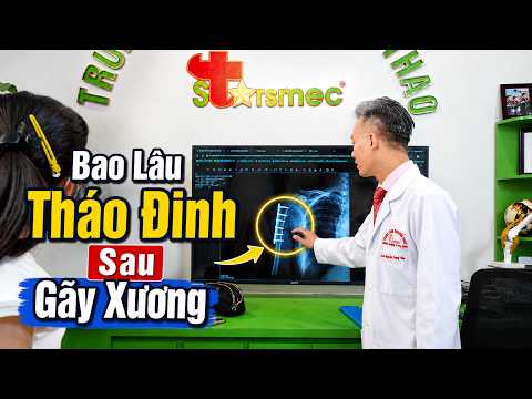 Sau Gãy Xương Bao Lâu Tháo Đinh? Đừng Nhìn Vào Số Tháng