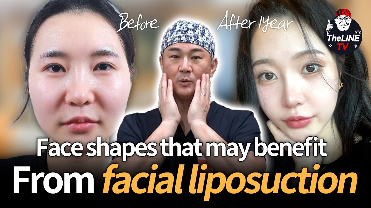 Face shapes that may benefit from facial liposuction - TheLINE Plastic Surgery video