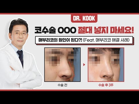코 성형 수술 시 절대 "ㅇㅇㅇ" 넣지 마세요! ❌ 부작용의 원인이 됩니다!