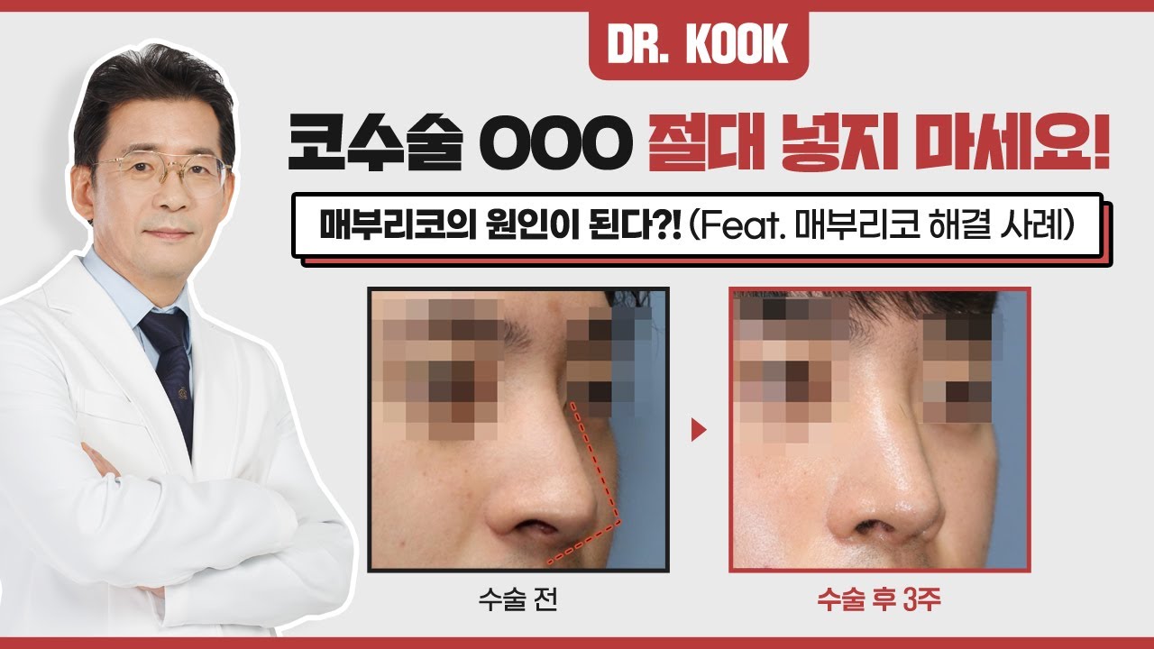 코 성형 수술 시 절대 "ㅇㅇㅇ" 넣지 마세요! ❌ 부작용의 원인이 됩니다! 썸네일