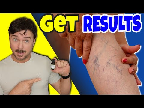 The 7-Day Spider Vein Solution That Actually Works!