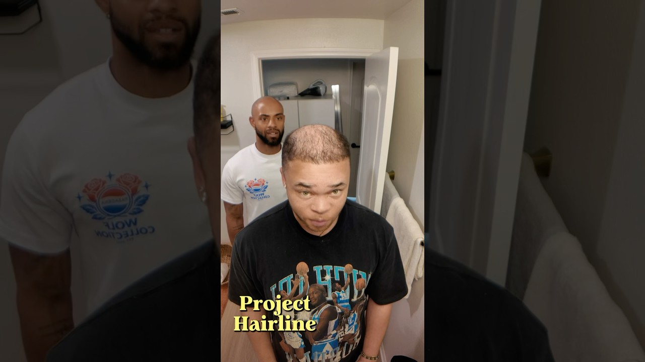 5 month hair transplant update. @JohnJonne