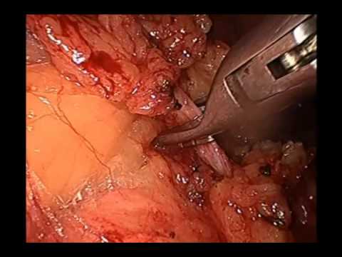 Triple-Track Technique For Laparosocpic Total Procto Colectomy