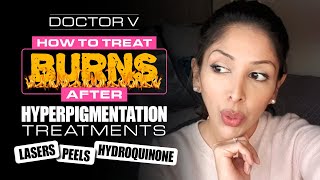Doctor V - How To Treat Burns after Hyperpigmentation Treatments | Skin of Colour |