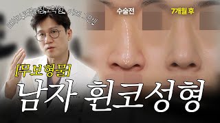 휜코+처진 코끝, 비염 해결! 30대 남자 무보형물 코성형 7개월 경과 (비중격 연골 + 근막)