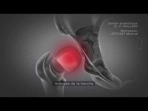 comment renforcer son cartilage