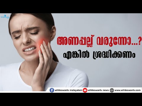 എന്തുകൊണ്ടാണ് അണപല്ല് വരുമ്പോൾ വേദന വരുന്നത്....|HEALTH TIPS | TEETH |