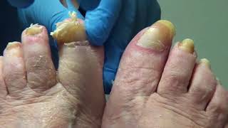 All Star Nail NipperPatient Films Own Procedure